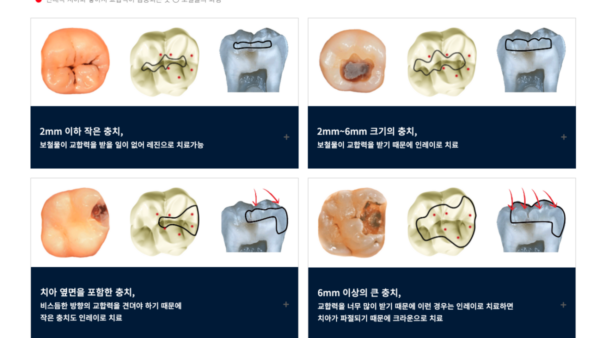 테스트포폴: 치과 충치치료관련 이미지